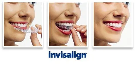 logo-invisalign-invisible-braces