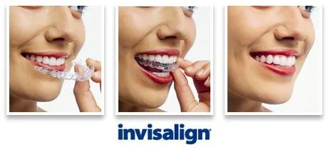 INVISALIGN. Invisible Orthodontics